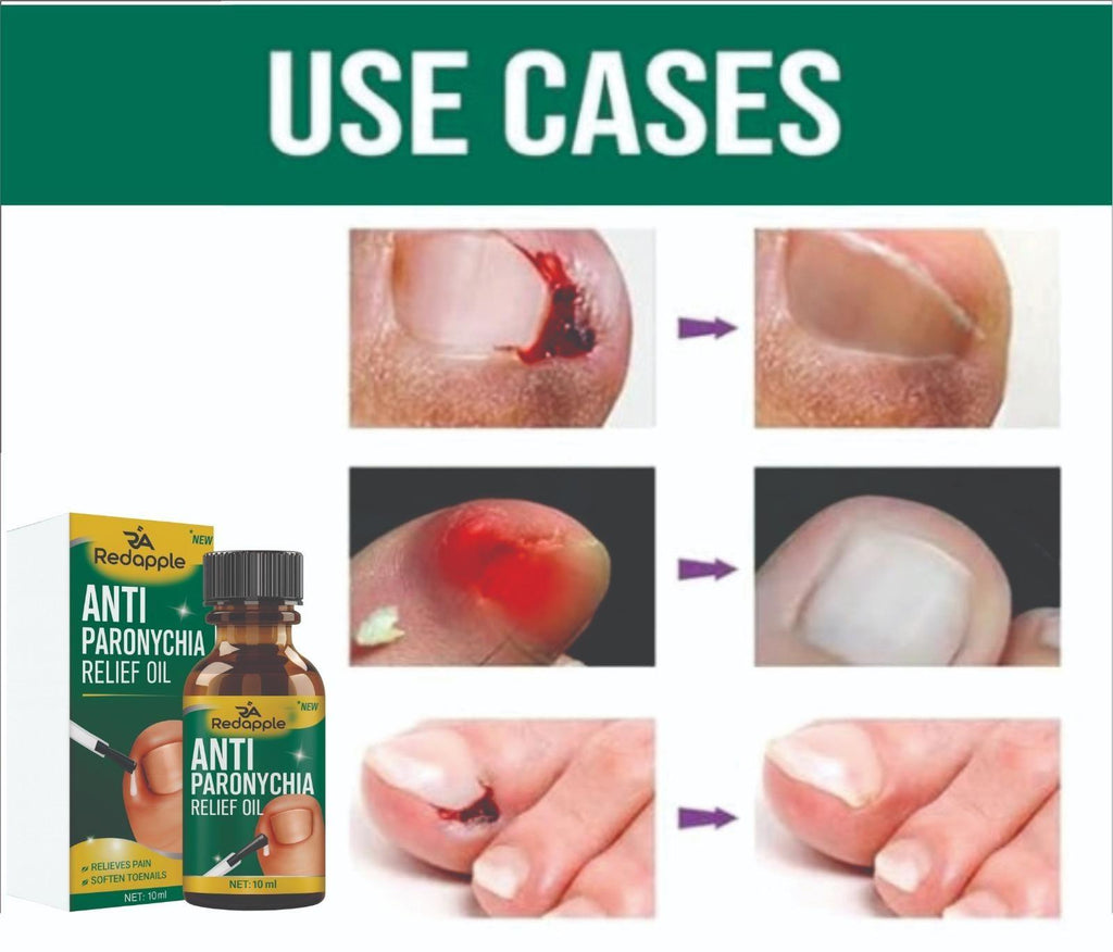 Anti Paronychia Relief Oil 10 ml Pack of 1